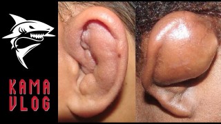 What is Cauliflower Ear? How to treat/prevent it?